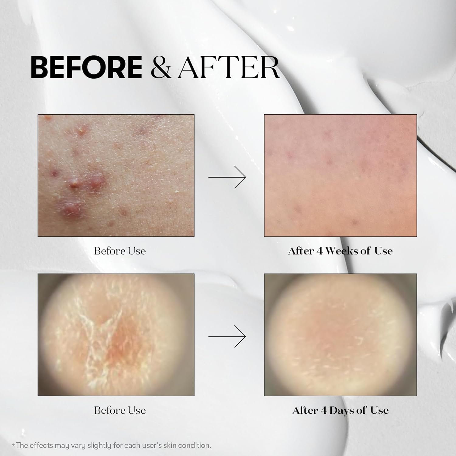 VT CICA REEDLE SHOT (Reedle Shot 100) - Image 5