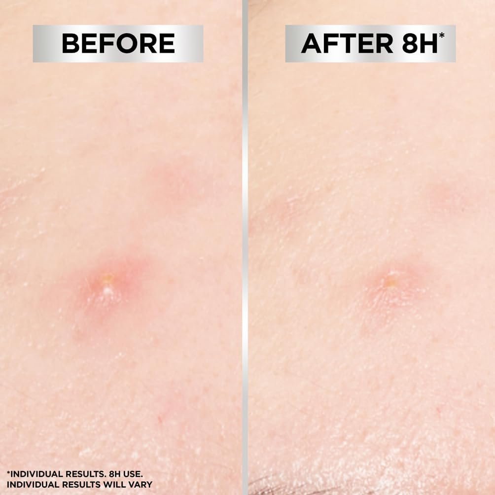 Garnier Blemish Patches, Hydrocolloid patches to reduce the appearance of spots in 8 hours, Ultra-thin & Invisible on all skin tones, Suitable For All Skin Types, Vegan Formula, 22 Patches - Image 5