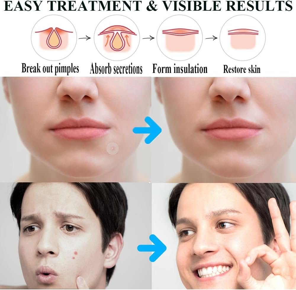 Zemolo 300pcs Pimple Patches Hydrocolloid Acne Stickers with Tea Tree Oil Spot Cover Patches Day & Night Whiteheads Acne Absorbing Blemish Patches Invisible Spot Treatment Stickers - Image 6