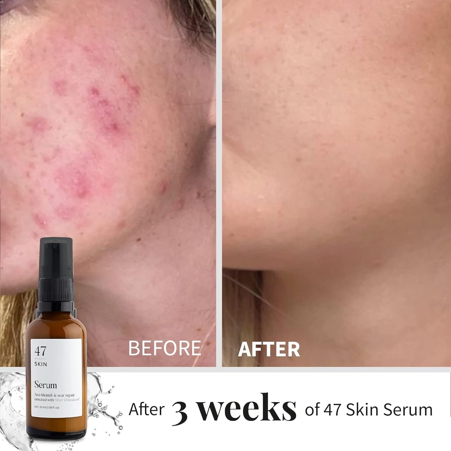 47 Skin Anti-blemish & scar repair Serum enriched with Silver Chitoderm for All Skin Types, Clear Skin Moisturiser, 50ml - Image 4