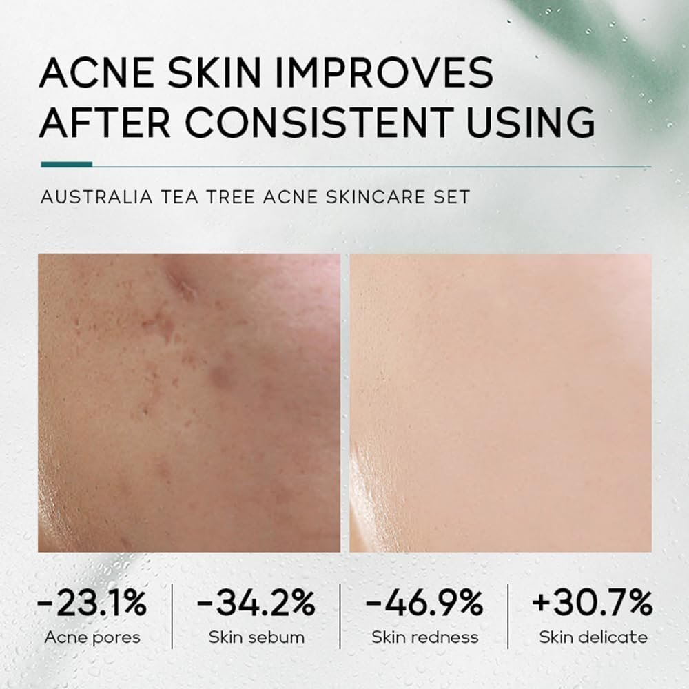 LAIKOU Tea Tree Acne Skincare Set, Facial Skin Care Sets & Kit with Cleanser, Toner, Serum, Cream, Gel, Acne Treatment Remove Shrink Pores Control Oil Gift for Teenage Girls Women All Skin - Image 4