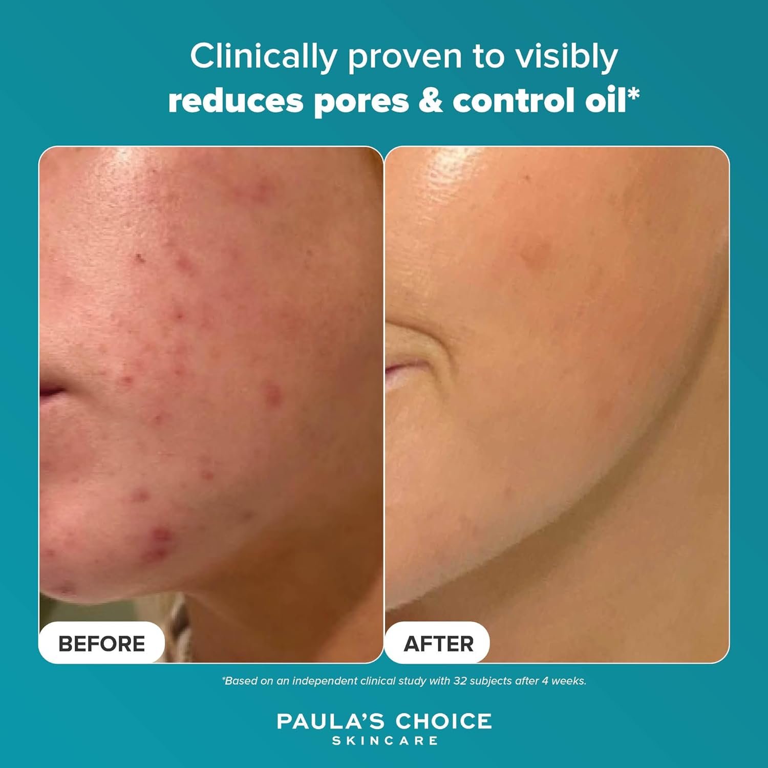 Paula's Choice SKIN PERFECTING 2% BHA Liquid Exfoliant - Face Exfoliating Peel Fights Blackheads & Enlarged Pores - for a Healthy Glow - with Salicylic Acid - Combination & Oily Skin - 30 ml - Image 5
