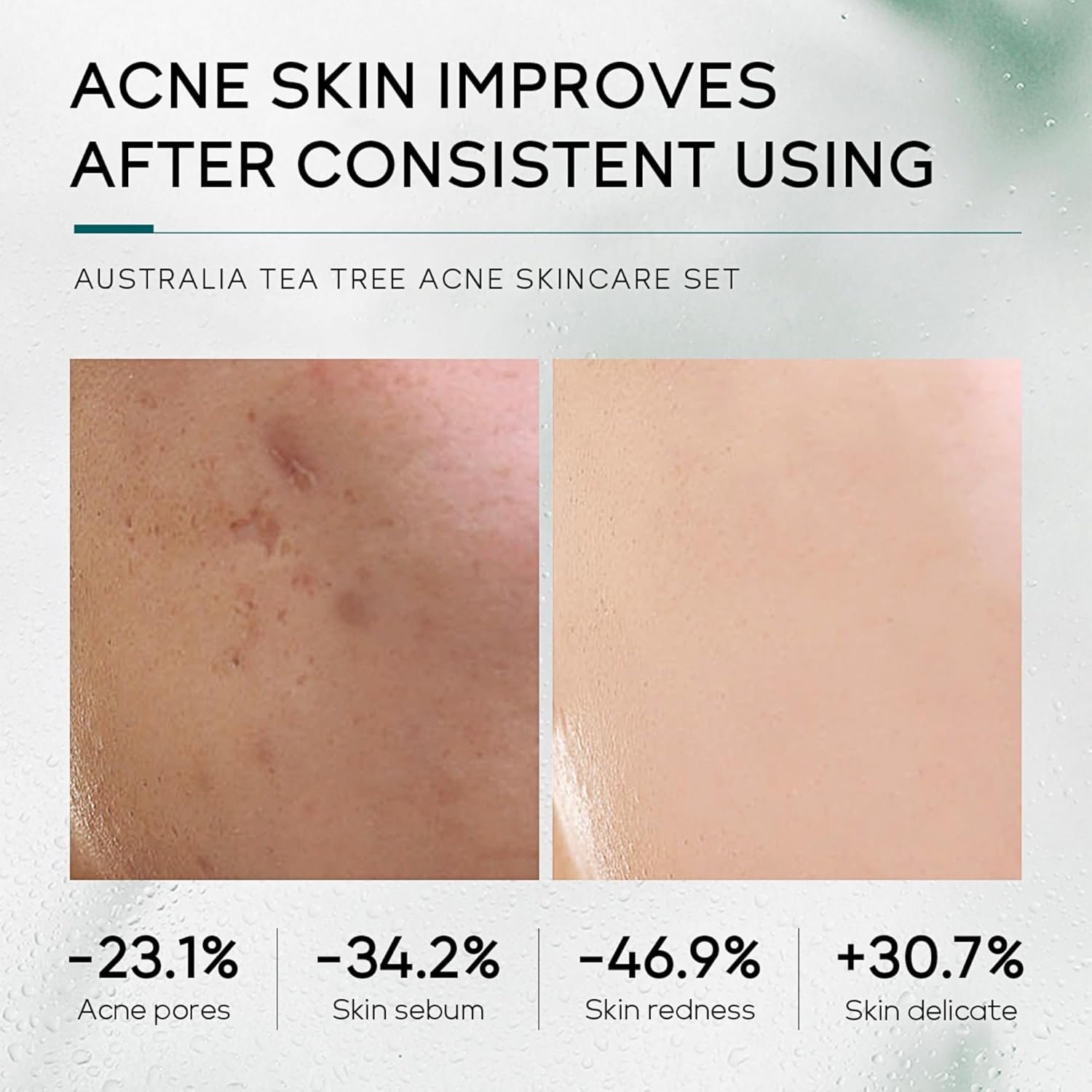 Tea Tree Acne Skin Care Sets & Kits, Tea Tree Oil For Skin, Teen Skincare Set With Cleanser,Toner,Serum,Cream,Gel, Rapid Relief Acne Treatment Shrink Pore Control Oil, Gifts For Teenagers Girls Boys - Image 6