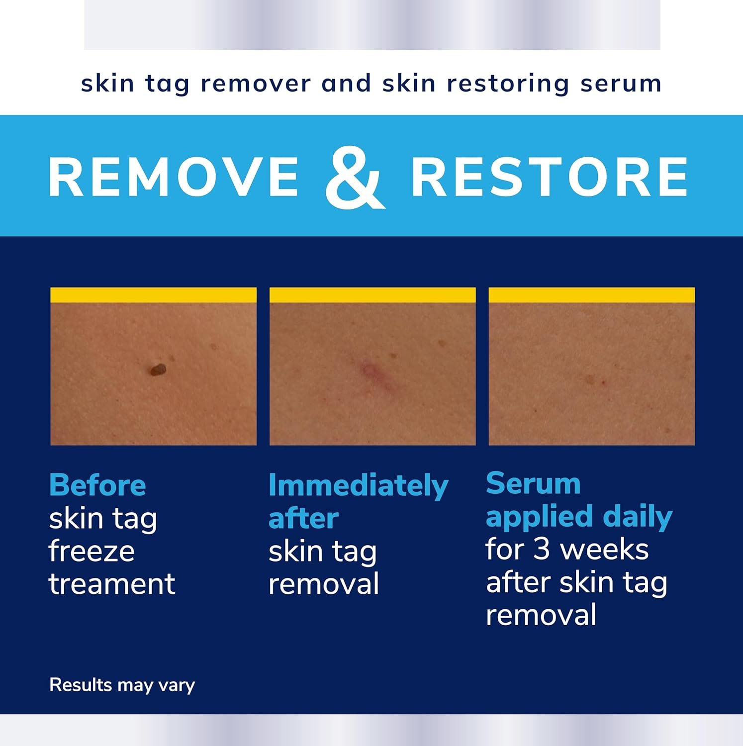 Scholl Complete Care Skin Tag Removal Kit - Safe & Effective Skin Tag Remover - Moisturising Serum Restores Skin's Appearance - Clinically Proven - 12 Treatments Plus Hydrating Serum - Image 6