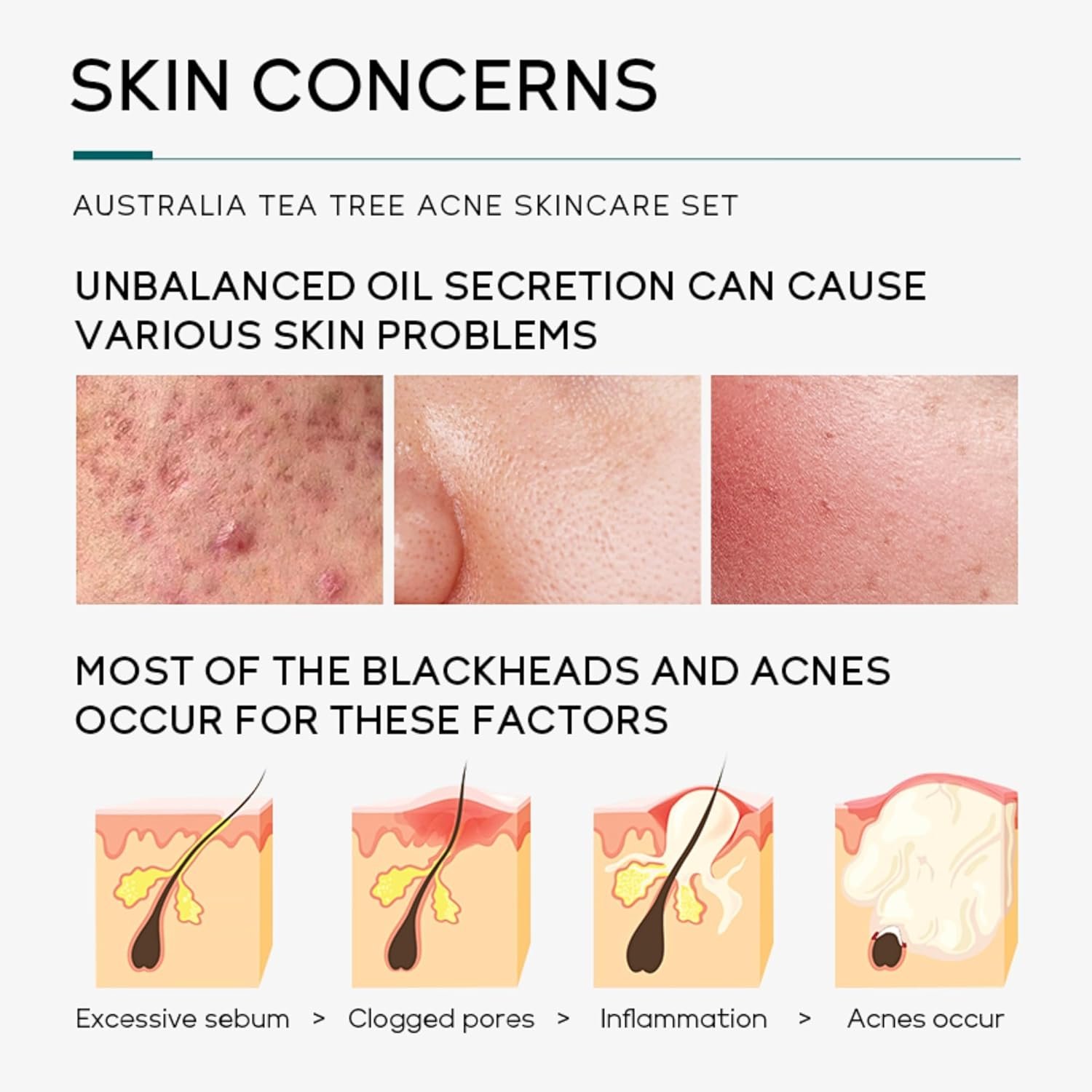 Tea Tree Acne Skin Care Sets & Kits, Tea Tree Oil For Skin, Teen Skincare Set With Cleanser,Toner,Serum,Cream,Gel, Rapid Relief Acne Treatment Shrink Pore Control Oil, Gifts For Teenagers Girls Boys - Image 5